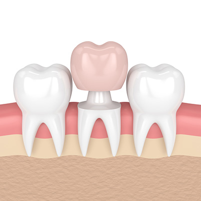 dental crown