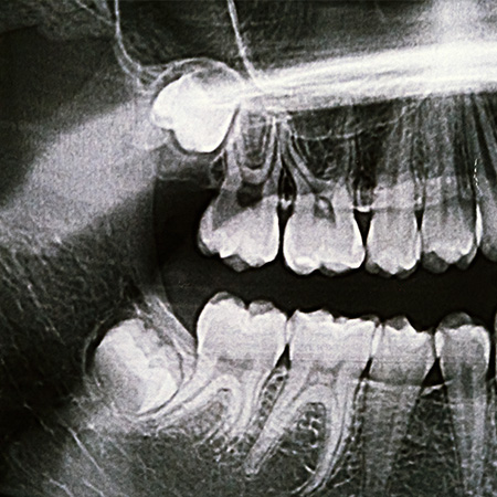 wisdom teeth photo