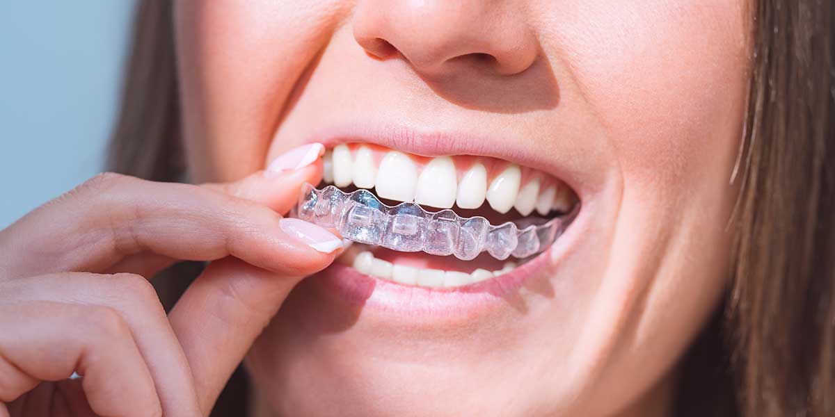 Five Benefits of Choosing Invisalign Over Braces
