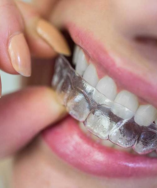 Can Invisalign fix overbite​