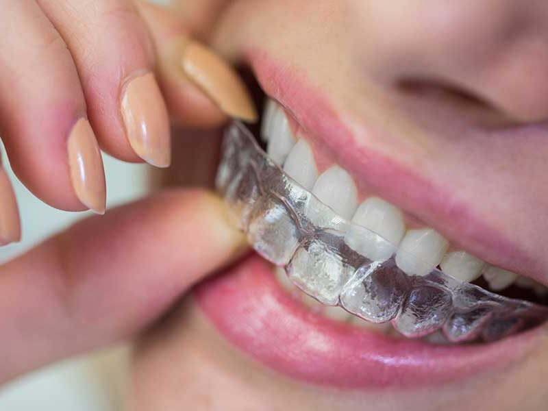 Can Invisalign fix overbite​