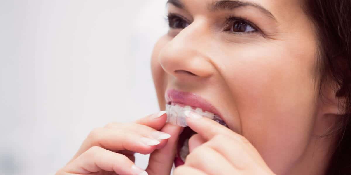 How Often Do You Need to Change Invisalign Trays?