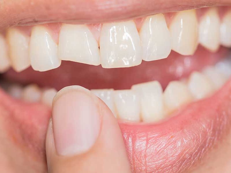 chipped tooth