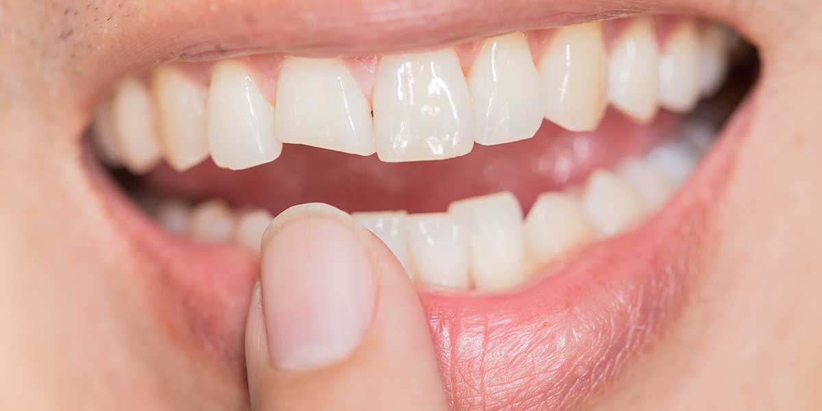 What to Do If You Have a Chipped Tooth