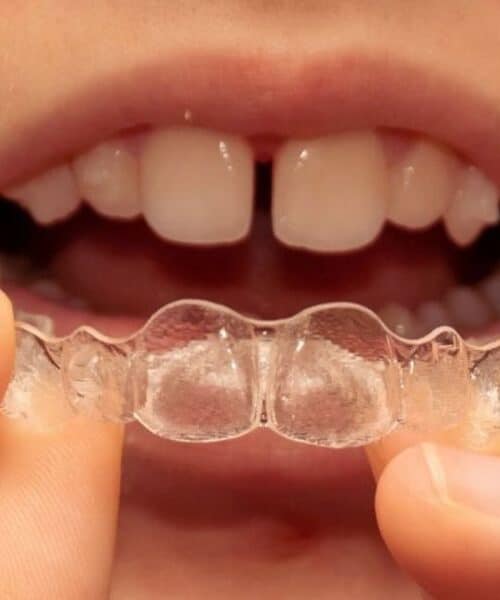 Patient wearing clear Invisalign aligners to close gaps between teeth and improve smile alignment | Can Invisalign Fix Gaps Between Your Teeth
