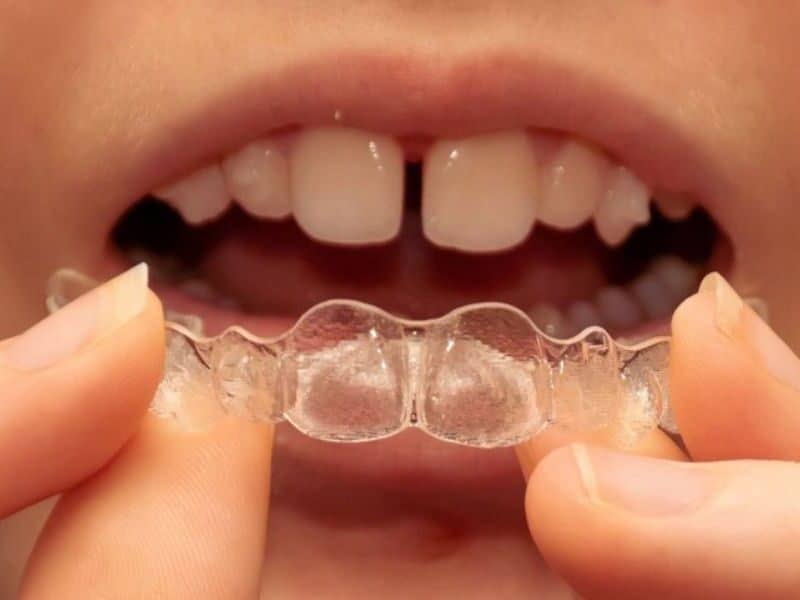 Patient wearing clear Invisalign aligners to close gaps between teeth and improve smile alignment | Can Invisalign Fix Gaps Between Your Teeth