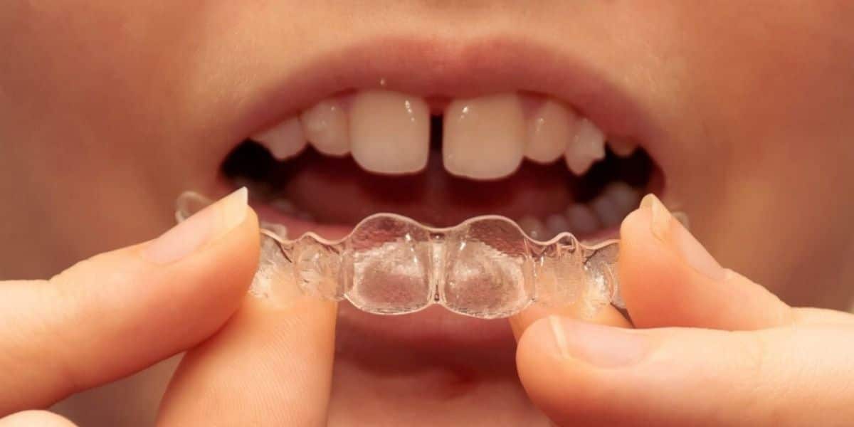 Can Invisalign Fix Gaps Between Teeth?