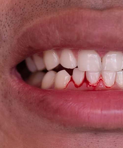 Person brushing teeth and noticing bleeding gums during oral hygiene routine | Why Do Your Gums Bleed When You Brush Your Teeth