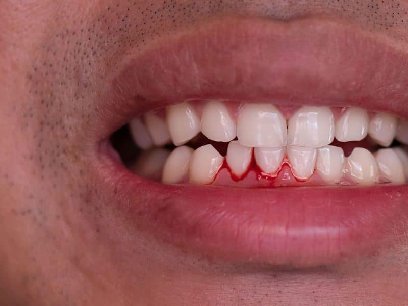 Person brushing teeth and noticing bleeding gums during oral hygiene routine | Why Do Your Gums Bleed When You Brush Your Teeth