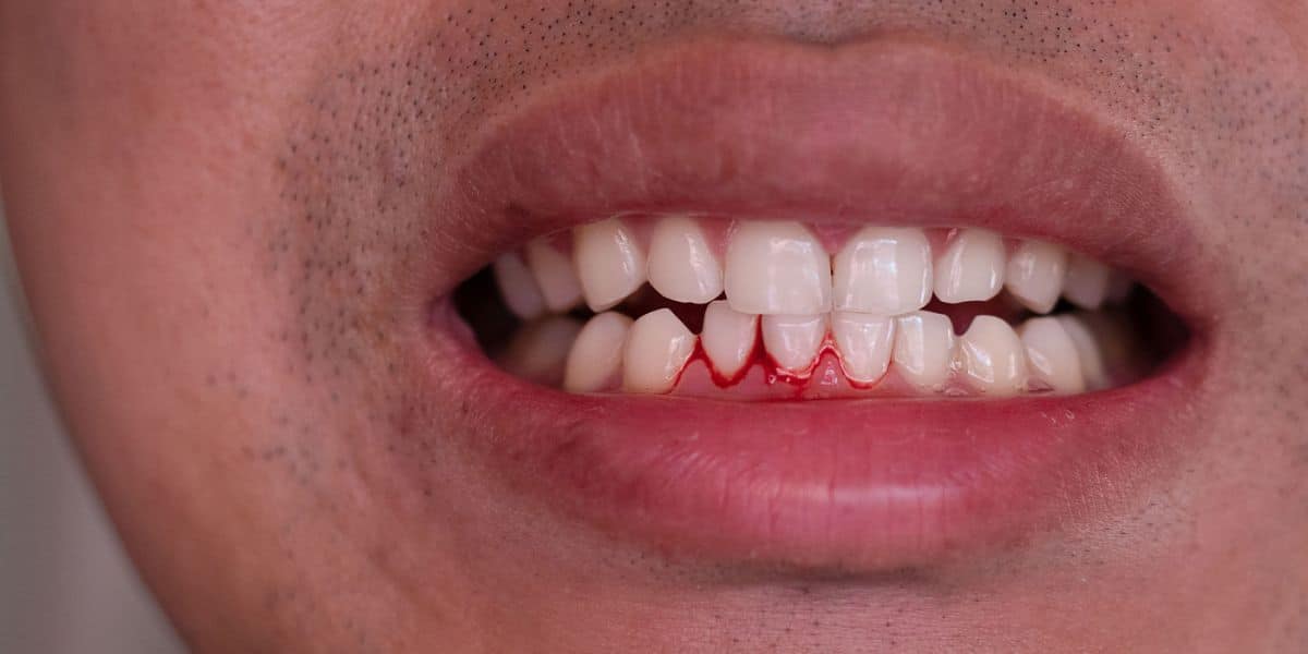 Why Do Your Gums Bleed When You Brush Your Teeth?