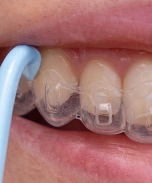 Orthodontist showing Invisalign clear aligners to a patient during a consultation about treatment duration | How Long Does Invisalign Treatment Take?