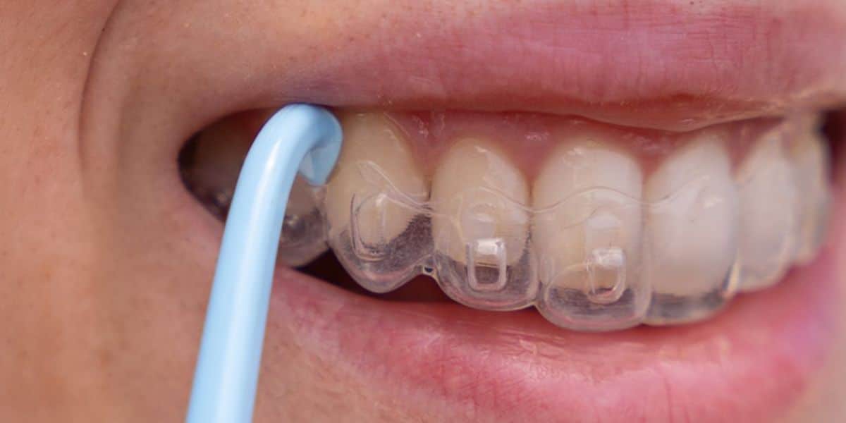 How Long Does Invisalign Treatment Take?