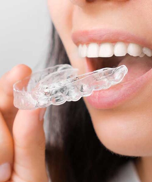 Close-up of a smiling woman inserting a clear Invisalign aligner over her straight white teeth for adult orthodontic treatment.